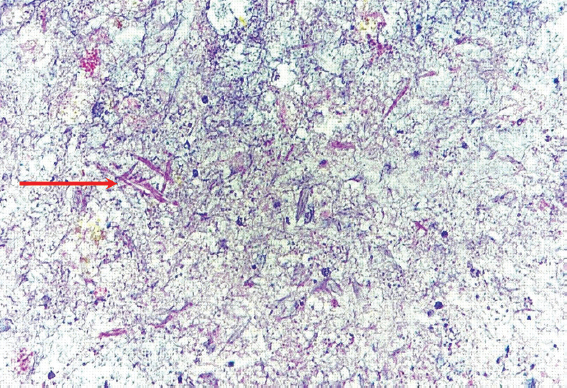 High-power magnification (×400) of H and E-stained section showing filamentous bacteria (arrow) in a background of necrosis and inflammation. The organisms were negative for special stains.